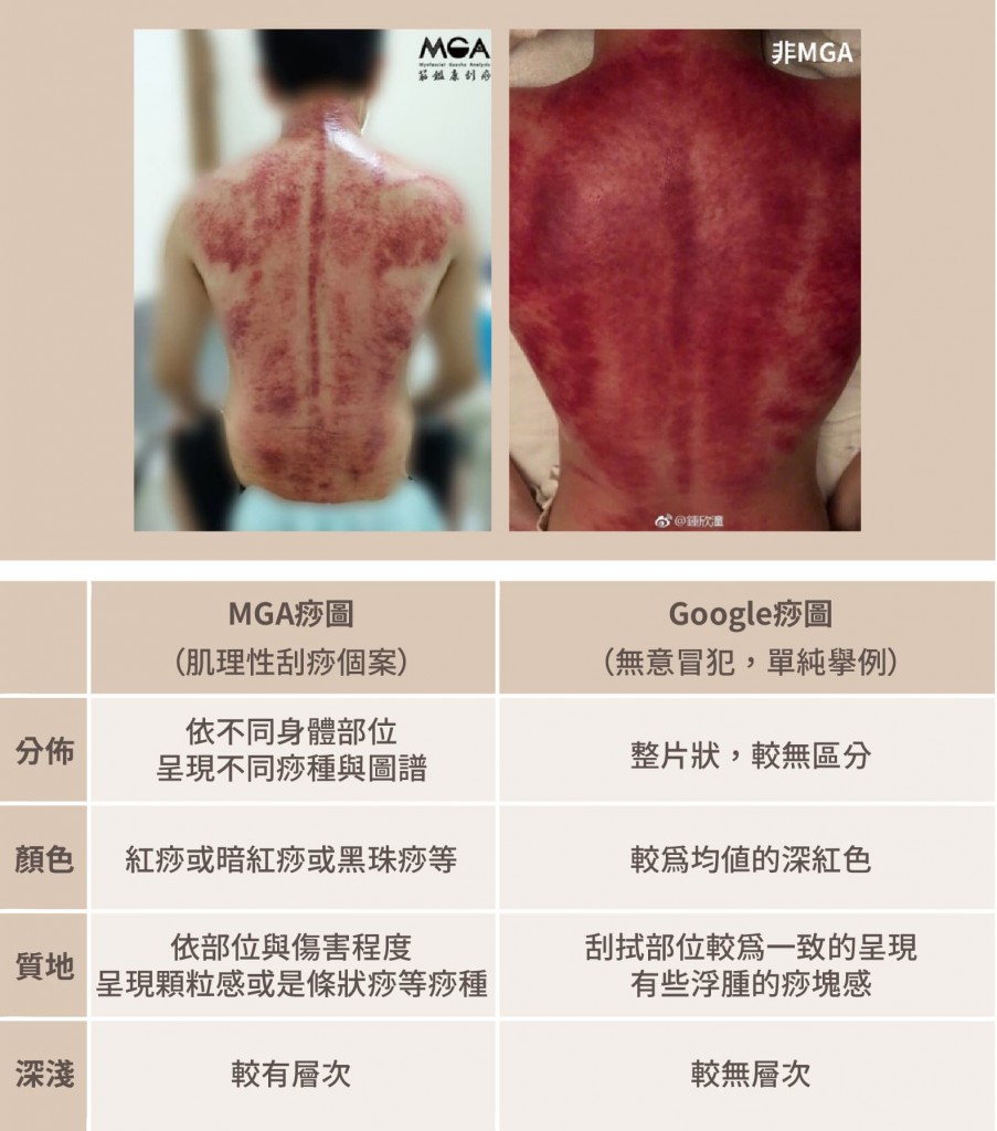 MGA筋鑑康刮痧|[刮痧知識] 不能常刮痧，不然會容易纖維化?! 會刮痧的你，不可不知的正確刮痧觀念！