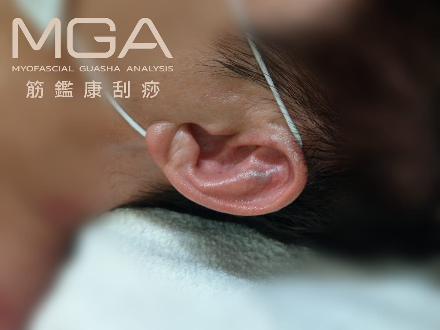 ［MGA隨堂考］耳朵上的痧種為？ 容易造成什麼問題？大部分是什麼原因造成的呢？